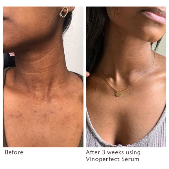 5/$15 😍 Caudalie Vinoperfect Radiance Serum Complexion Correcting Sample Size💙 - Picture 2 of 8